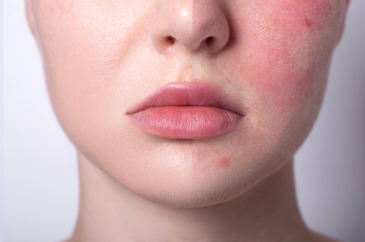 Gesichtshälfte mit geröteter Haut – typische Symptome vor einer Behandlung wie Couperose lasern