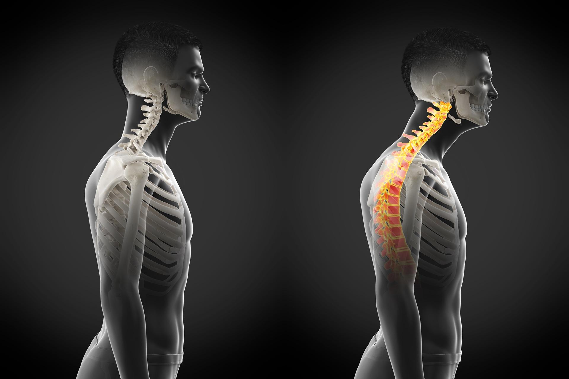 Anatomie schlechte Haltung Wirbelsäulenbelastung | Umzugsunternehmen Lippstadt